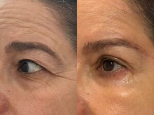 antesedepoissupercilios